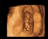 Ultrasound HH 12 Weeks