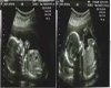 twin fetus ultrasound