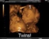 twins sonogram sticker