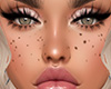Freckles