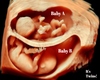 Twins HH Ultrasound