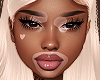 Vitiligo MH