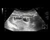 twin 6wk ultrasound