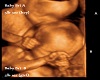 Bri Twin Ultrasound