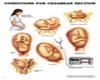 LUVI C-SECTION POSTER