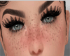 Freckles