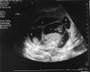 quintuplets ultrasound