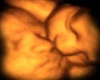 Twin Kiss Ultrasound Pic