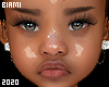 Serena MH -T2 Vitiligo