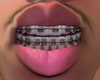odell braces v1