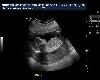 Jessica Ultrasound