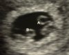 7 week Twin Sonogram