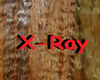 BR)HOSP X-RAY SIGN