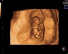 Missy's Ultrasound Pic