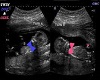 GMC Twin Ultrasound 4 M